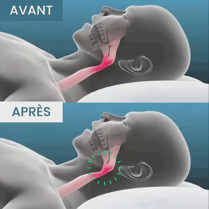 Embout buccal Arshon™